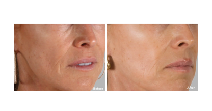 AnteAGE MD  System