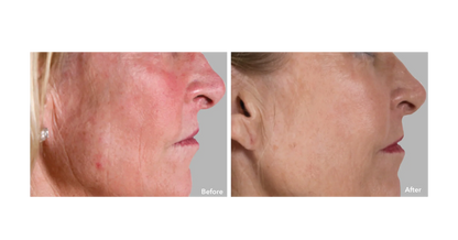 AnteAGE MD  System